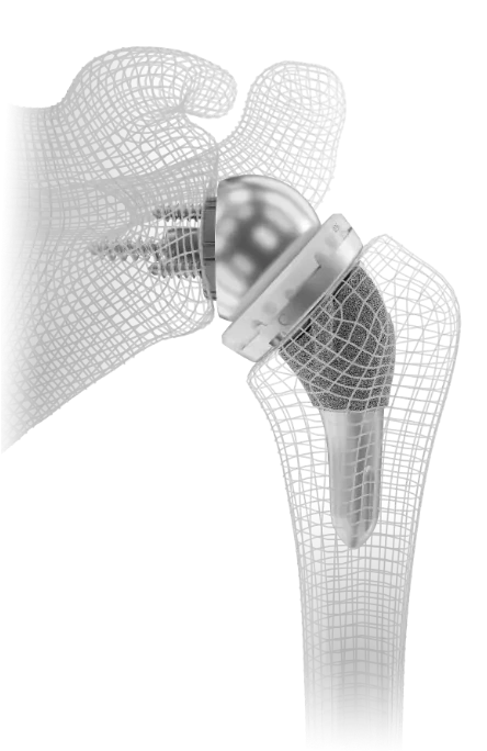 InSet® reverse shoulder replacement implant from Shoulder Innovations