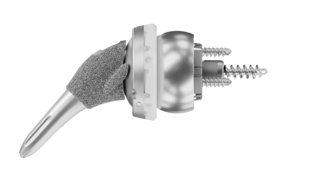 InSet® reverse shoulder replacement implant from Shoulder Innovations