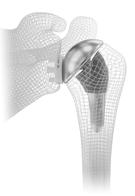 InSet® anatomic total shoulder replacement implant from Shoulder Innovations