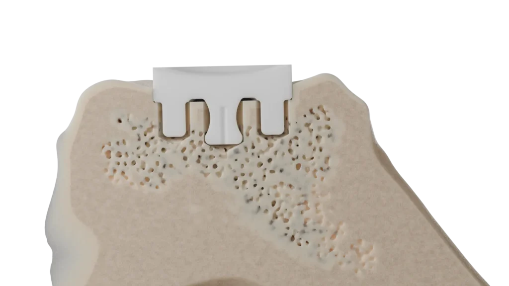 InSet® glenoid implant seated within the glenoid bone
