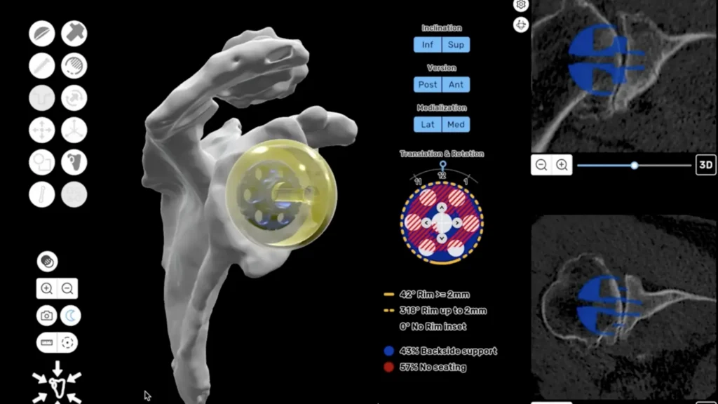 3D CT-based preoperative plan for a reverse shoulder replacement