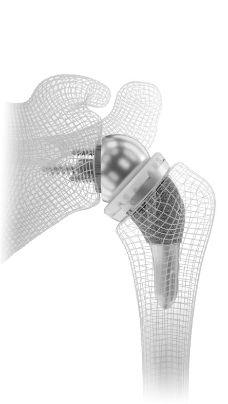 InSet® reverse shoulder replacement implant shown in a bone model