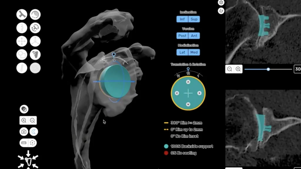 3D CT-based preoperative plan for a total shoulder replacement