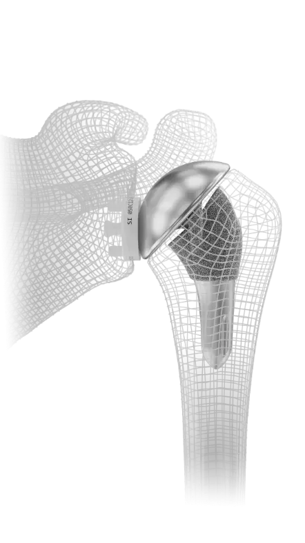 InSet® total shoulder replacement implant shown in a bone model